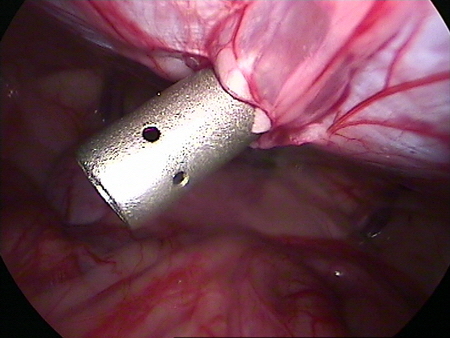 Endoskopische Kastration Laparoskopie Trokar