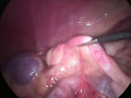 Endoskopische Kastration Hund Eierstock und Uterus