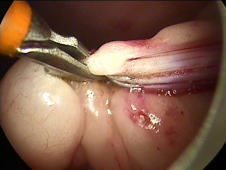 Endoskopische Kastration Ovar Vessel Sealing