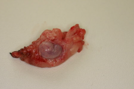 Endoskopische Kastration entfernter Eierstock