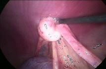 Endoskopische Kastration Eierstock (Ovar) hochgehalten
