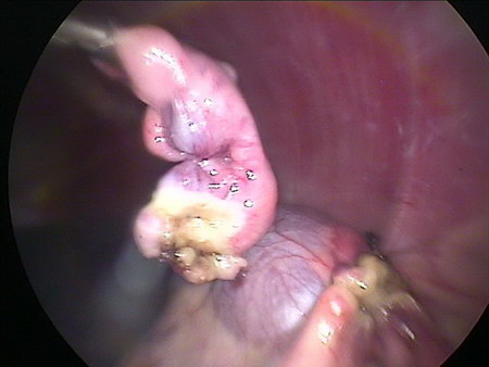 endoskopische Kastration Eierstock (Ovar) isoliert