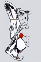 DBO Osteotomielinien DBO Osteotomielinien