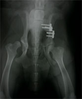 schwere HD mit Luxation nach DBO schwere HD mit Luxation nach DBO