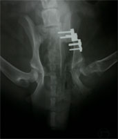 schwere HD mit Luxation nach DBO schwere HD mit Luxation nach DBO