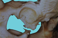 DBO arthrosefreies Hüftgelenk nach 8 Jahren DBO arthrosefreies Hüftgelenk nach 8 Jahren