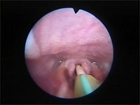 Abb 17 Vorschieben-des-Tracheotubu Abb 17 Vorschieben-des-Tracheotubu