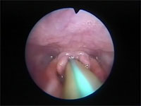 Abb 18 Tracheotubus-in-Trachea