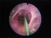 Abb 19 Extubation Abb 19 Extubation