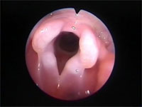 Abb 1 Kehlkopf-offen Abb 1 Kehlkopf-offen