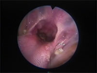 Abb 2 Larynx-schwer-einsehbar Abb 2 Larynx-schwer-einsehbar