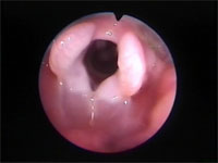 Abb 6 Laryngeales-Ödem Abb 6 Laryngeales-Ödem