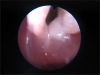 Abb 7 Rima-offen-Plica-zu Abb 7 Rima-offen-Plica-zu