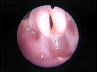 Abb 8 Schlüsselloch-beim-Laryngos Abb 8 Schlüsselloch-beim-Laryngos
