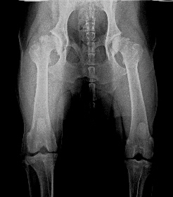 Abb 2 Arthrotisch zerstrtes Hftgelenk (Coxarthrose) als Folge der HD