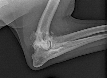 Ellbogengelenk mit weit fortgeschrittener Arthrose als Sptfolge einer ED bzw. Kompartmentsyndrom