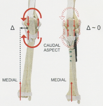 PAUL Umstellungsosteotomie: die Ulna wird unterhalb des Ellbogengelenkes lateralisiert ( Abb. KYON AG Switzerland mit freundlicher Genehmigung).